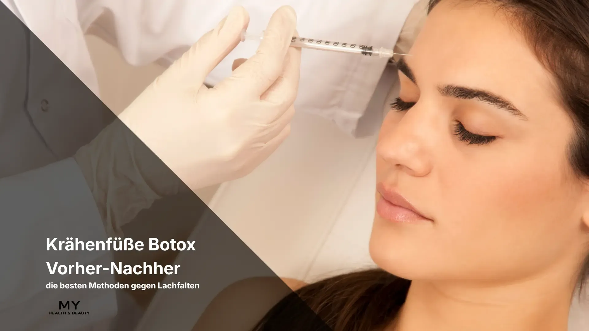Krähenfüße Botox Vorher-Nachher & die besten Methoden gegen Lachfalten