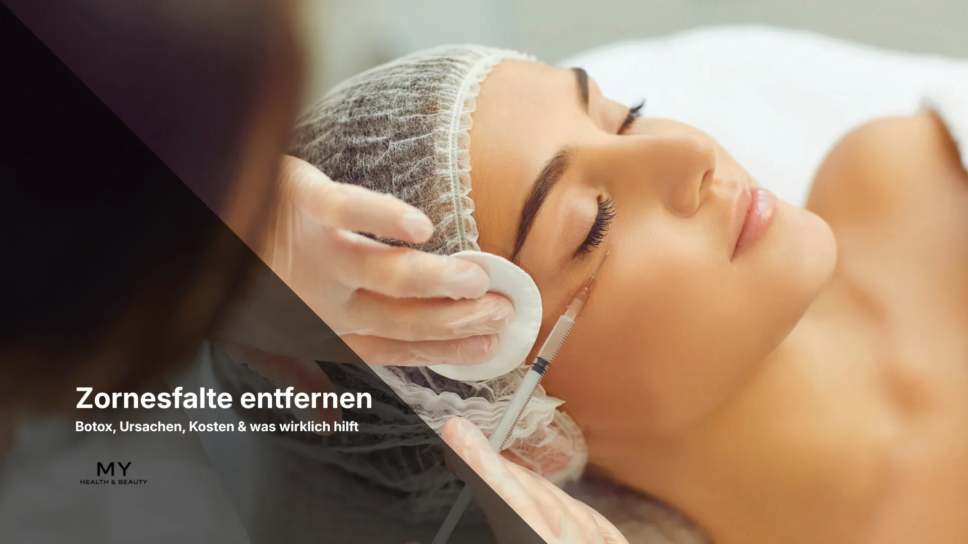 Zornfalte Botox bei MY 