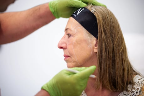 3 Zonen Botox – Preise, Ablauf & natürliche Ergebnisse
