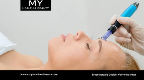 Mesotherapie Gesicht Vorher Nachher – Ergebnisse, Wirkung und Kosten