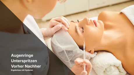 Augenringe Unterspritzen Vorher Nachher 