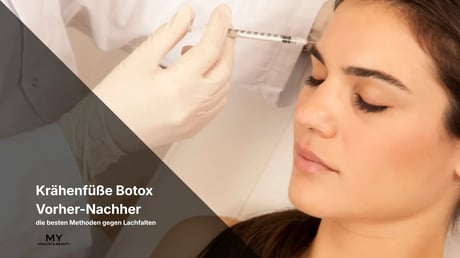 Krähenfüße Botox Vorher-Nachher & die besten Methoden gegen Lachfalten