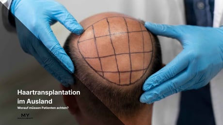 Haartransplantation im Ausland: Worauf müssen Patienten achten?