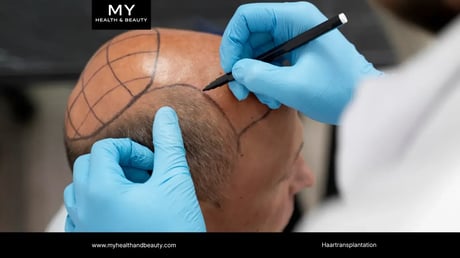 Haartransplantation