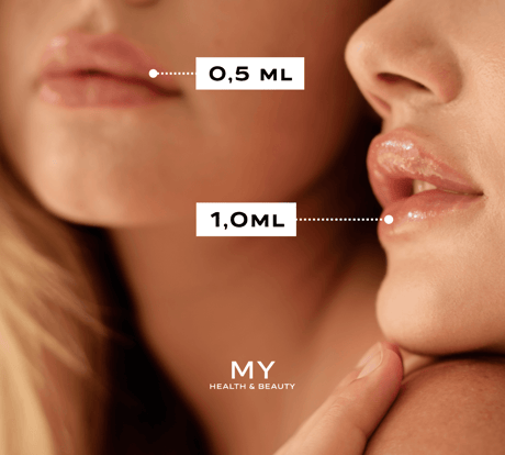 Lippen aufspritzen 0.5 und 1,0