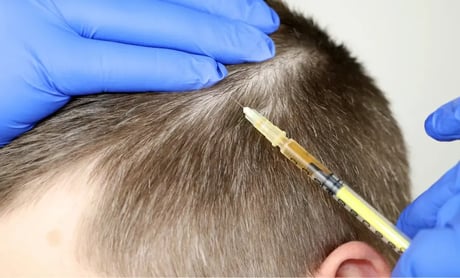 Mesotherapie Haare MY HEALTH AND BEAUTY