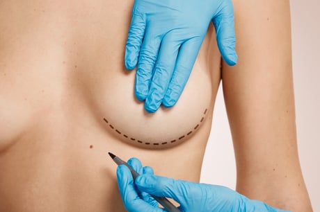Brustvergrößerung - MY HEALTH AND BEAUTY