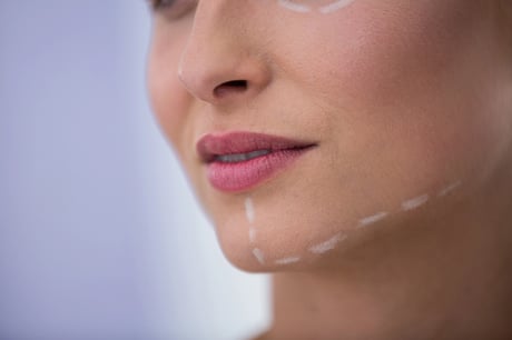 Jawline unterspritzen mit Hyaluron my health and beauty 